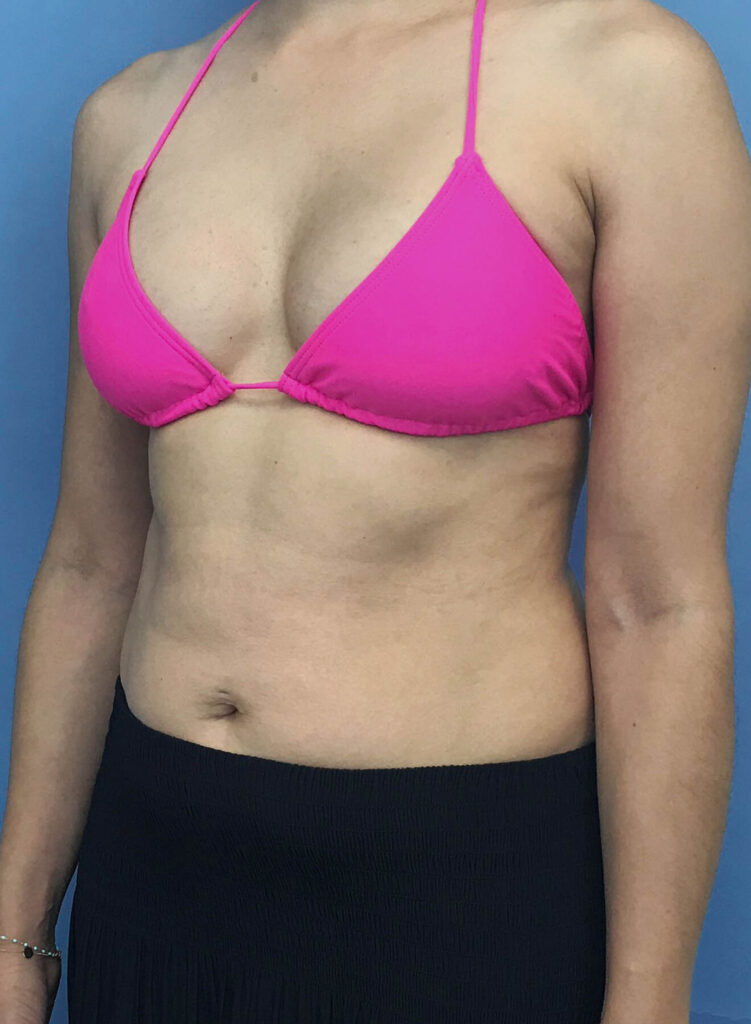 Case BAI-0378 after photo — Dr. Cat, Beverly Hills