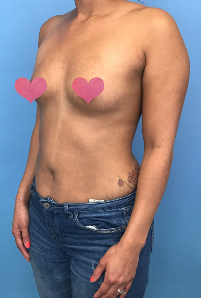 Case BAI-0423 before photo — Dr. Cat, Beverly Hills
