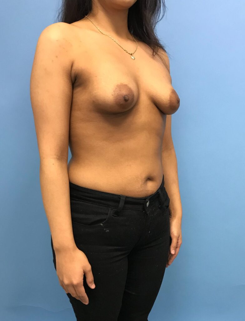 Case BAI-0529 before photo — Dr. Cat, Beverly Hills