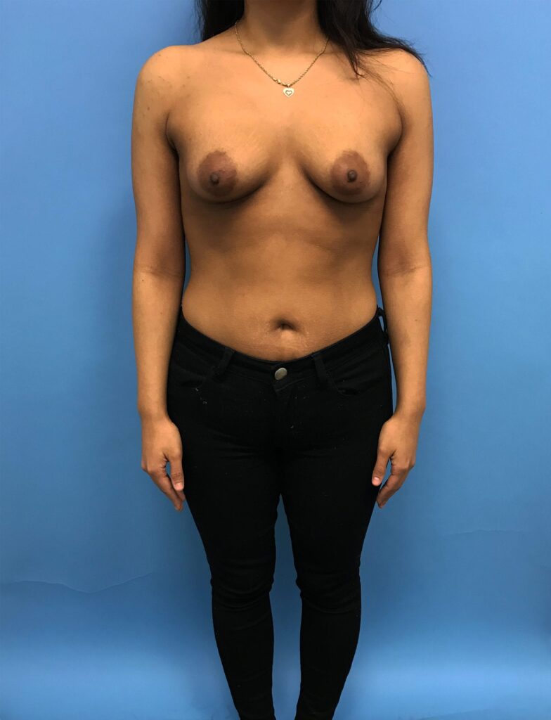 Case BAI-0529 before photo — Dr. Cat, Beverly Hills