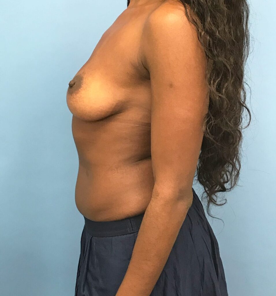 Case BAI-0414 before photo — Dr. Cat, Beverly Hills