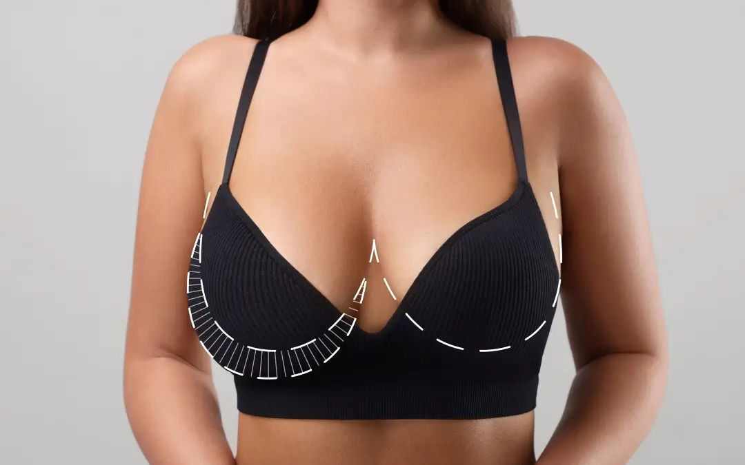 Breast Reduction patient results - Dr. Cat Beverly Hills