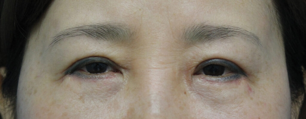 Case ELF-P1 before photo — Dr. Cat, Beverly Hills
