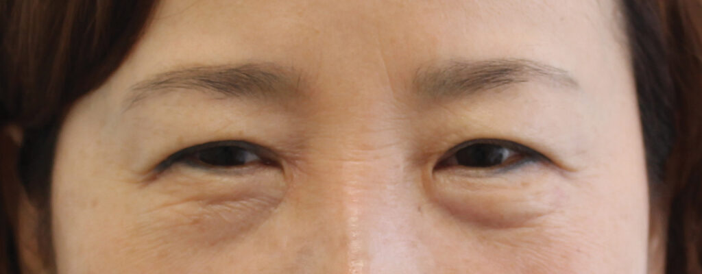 Case ELF-P1 after photo — Dr. Cat, Beverly Hills
