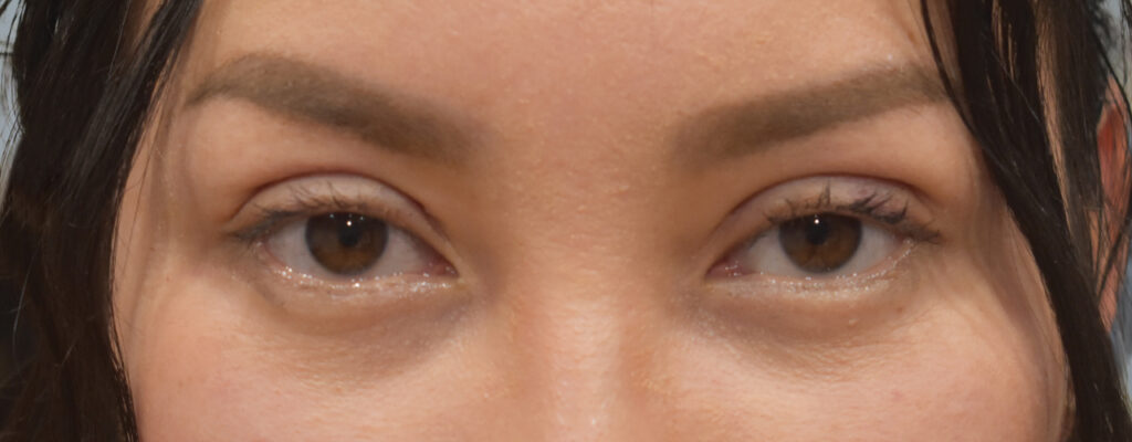 Case ELF-P5 before photo — Dr. Cat, Beverly Hills
