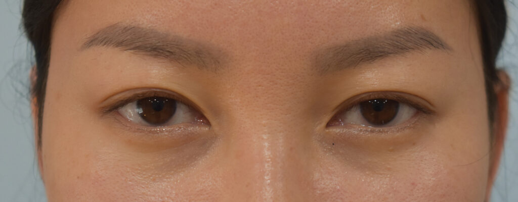 Case ELF-P5 after photo — Dr. Cat, Beverly Hills