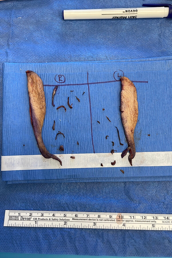 Labiaplasty patient results - Dr. Cat Beverly Hills