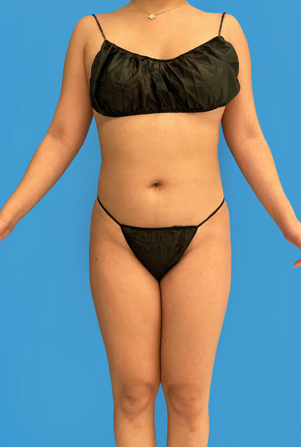 Liposuction after photo - Dr. Cat Beverly Hills