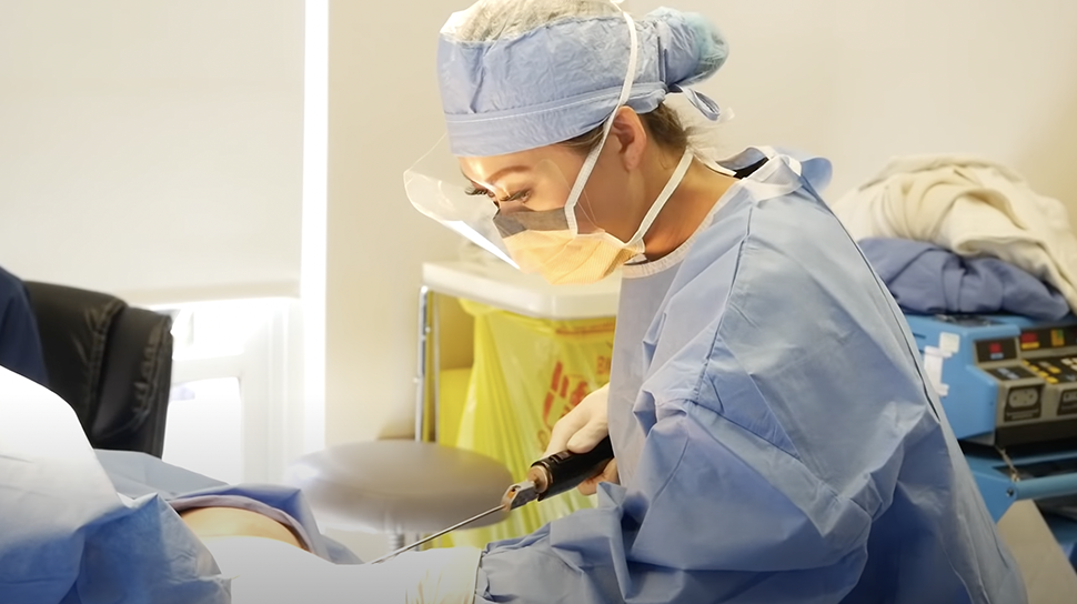 Liposuction patient results - Dr. Cat Beverly Hills