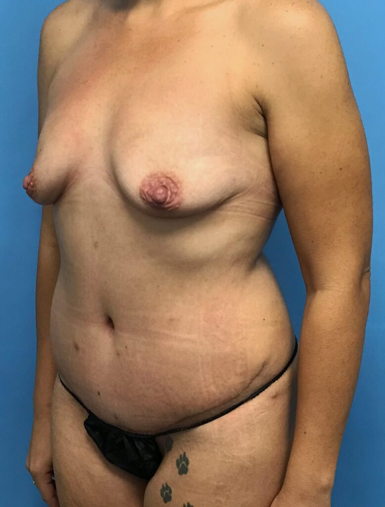 Case BAI-0373 before photo — Dr. Cat, Beverly Hills