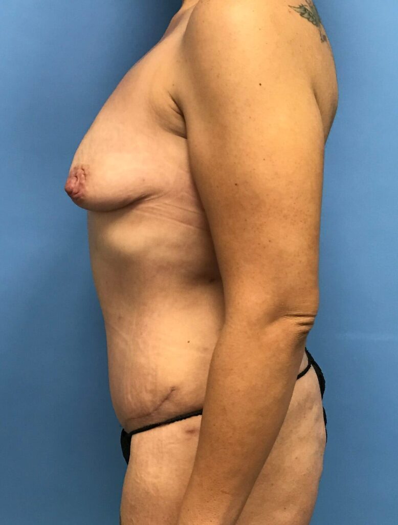 Case BAI-0373 before photo — Dr. Cat, Beverly Hills
