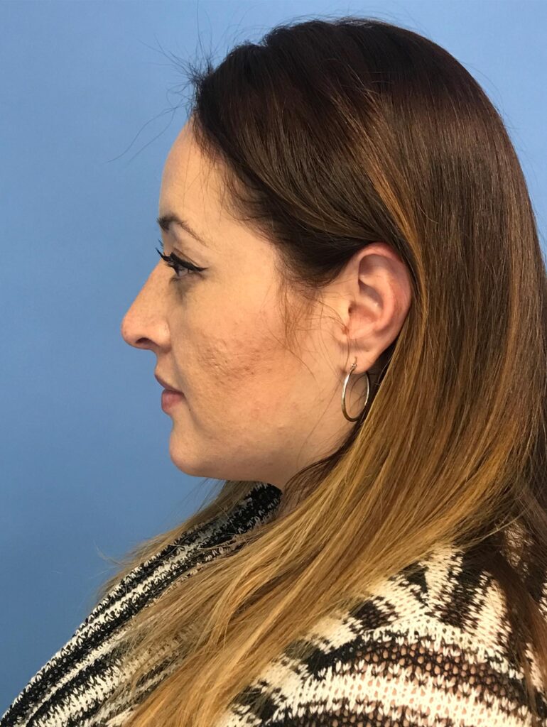 Case RHY-0477 after photo — Dr. Cat, Beverly Hills
