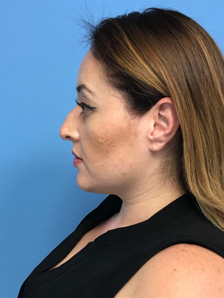 Case RHY-0477 before photo — Dr. Cat, Beverly Hills
