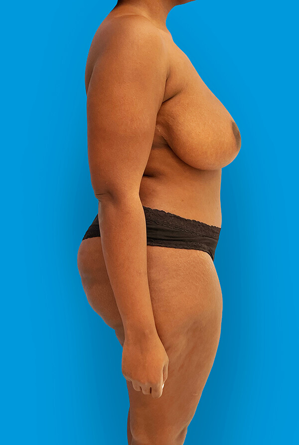 Tummy Tuck before photo profile view - Dr. Cat Beverly Hills