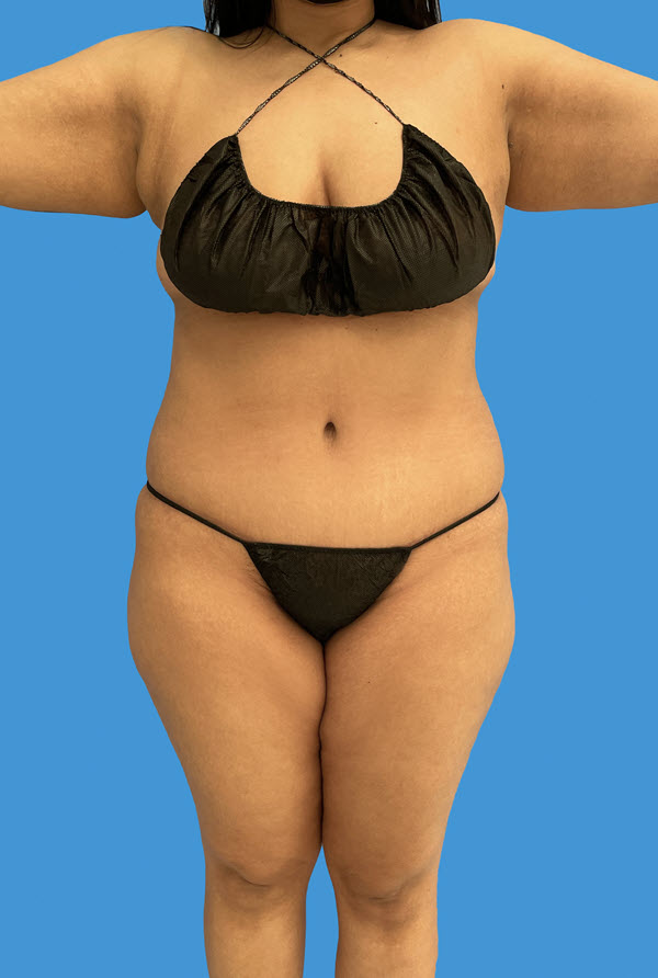 Tummy Tuck after photo - Dr. Cat Beverly Hills
