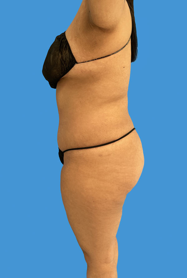 Tummy Tuck after photo profile view - Dr. Cat Beverly Hills