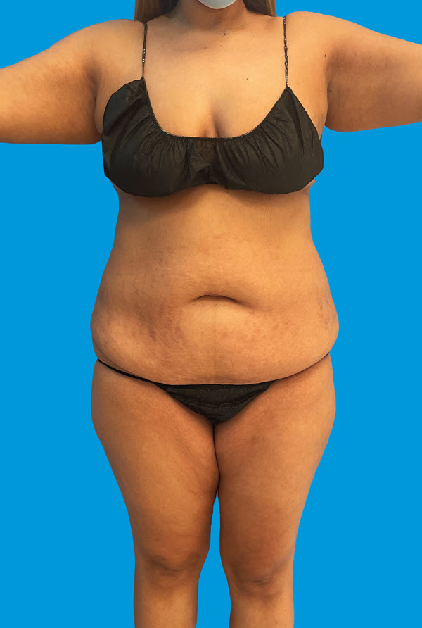 Tummy Tuck before photo - Dr. Cat Beverly Hills