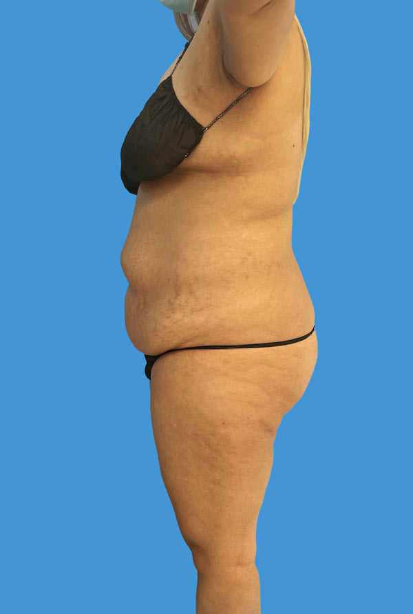 Tummy Tuck before photo profile view - Dr. Cat Beverly Hills