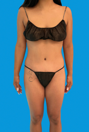 Front view of a woman's body after cosmetic procedure, showcasing a toned abdomen, defined waist, and improved body symmetry.