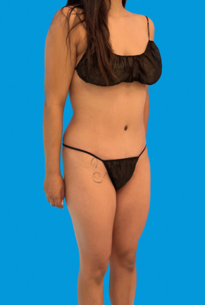 Front angled view of a woman's body post-cosmetic procedure, highlighting improved body contours and a slimmer abdominal area.