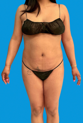 Front view of a woman's body before cosmetic procedure, displaying abdominal fullness and uneven body contours.