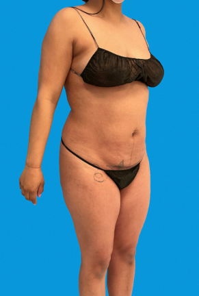 Front angled view of a woman's body before cosmetic procedure, showing abdominal fullness and uneven contours targeted for enhancement.