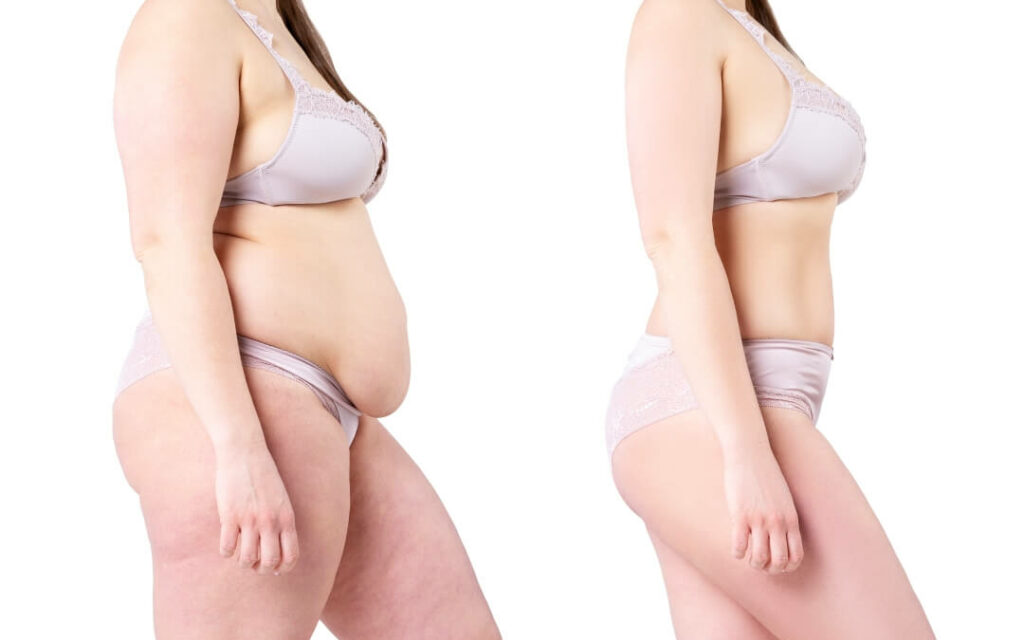 Tummy Tuck patient results - Dr. Cat Beverly Hills