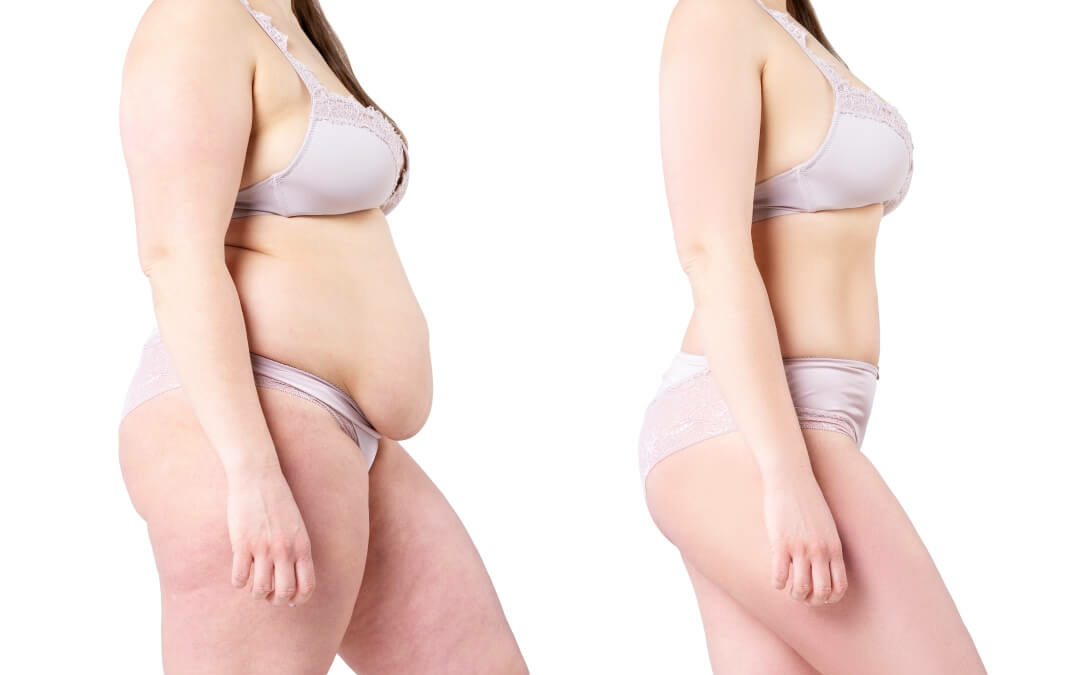 Tummy Tuck patient results - Dr. Cat Beverly Hills