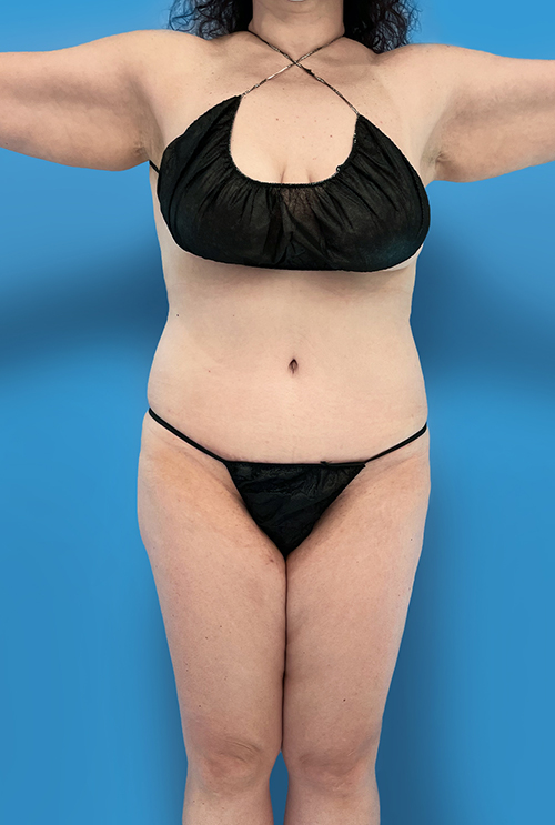 Tummy Tuck after photo front view - Dr. Cat Beverly Hills