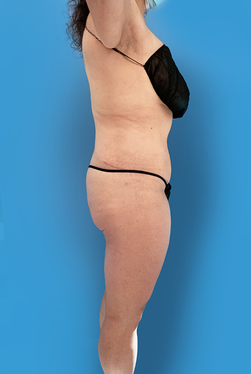 Tummy Tuck after photo side view - Dr. Cat Beverly Hills