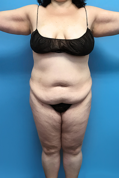 Tummy Tuck before photo front view - Dr. Cat Beverly Hills