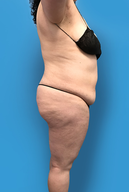 Tummy Tuck before photo side view - Dr. Cat Beverly Hills