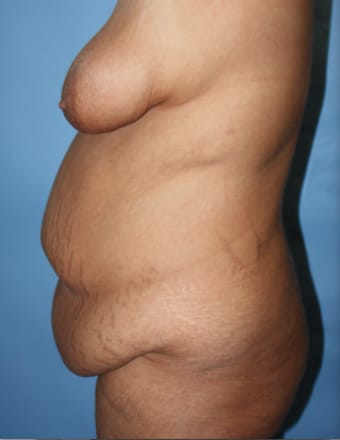 Tummy Tuck before photo - Dr. Cat Beverly Hills