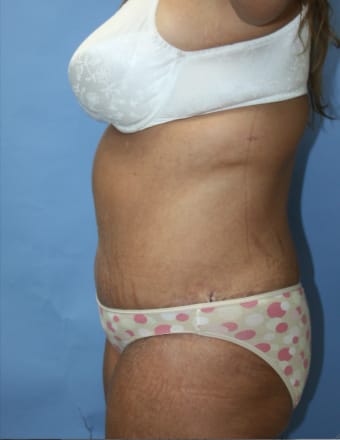 Tummy Tuck after photo - Dr. Cat Beverly Hills