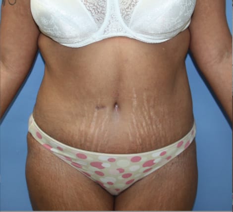 Tummy Tuck after photo - Dr. Cat Beverly Hills