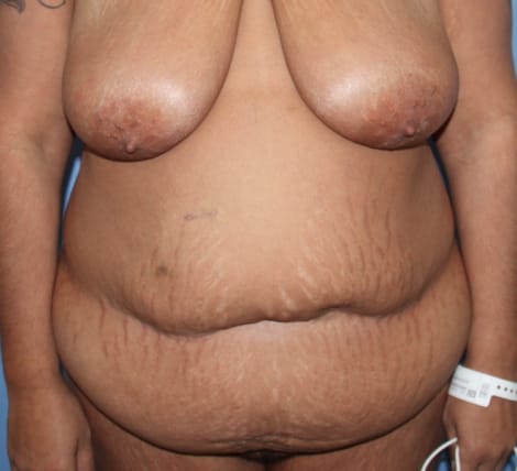 Tummy Tuck before photo - Dr. Cat Beverly Hills