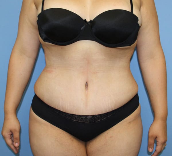 Tummy Tuck after photo - Dr. Cat Beverly Hills