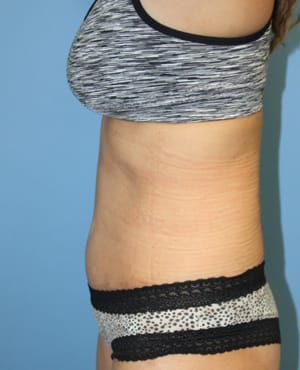 Tummy Tuck after photo - Dr. Cat Beverly Hills