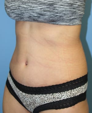 Tummy Tuck after photo - Dr. Cat Beverly Hills