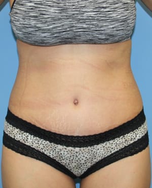 Tummy Tuck after photo - Dr. Cat Beverly Hills