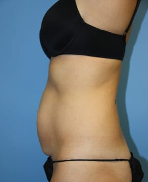 Tummy Tuck before photo - Dr. Cat Beverly Hills