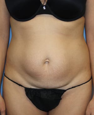 Tummy Tuck before photo - Dr. Cat Beverly Hills