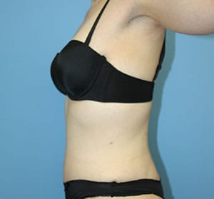 Tummy Tuck after photo - Dr. Cat Beverly Hills