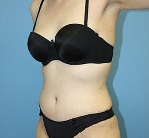 Tummy Tuck after photo - Dr. Cat Beverly Hills