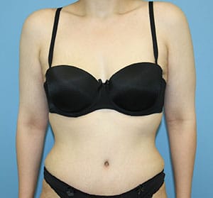 Tummy Tuck after photo - Dr. Cat Beverly Hills
