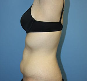 Tummy Tuck before photo - Dr. Cat Beverly Hills