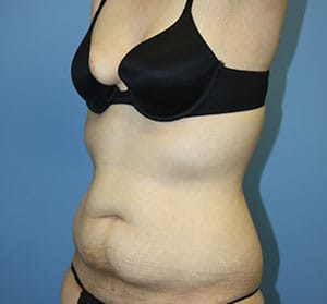 Tummy Tuck before photo - Dr. Cat Beverly Hills