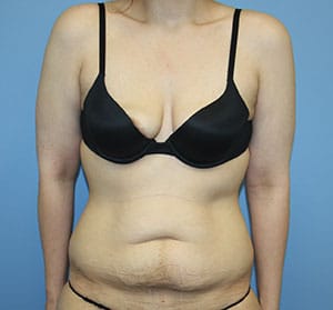 Tummy Tuck before photo - Dr. Cat Beverly Hills