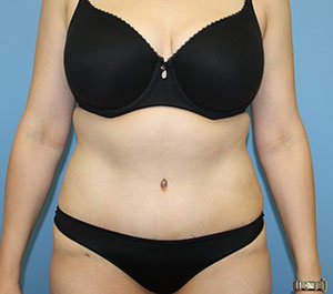 Tummy Tuck after photo - Dr. Cat Beverly Hills
