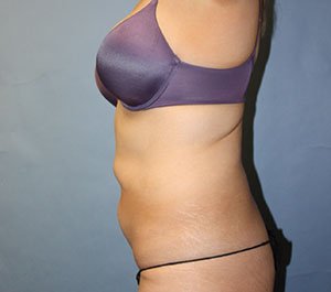 Tummy Tuck before photo - Dr. Cat Beverly Hills